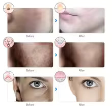 Advanced Led Therapy Mask